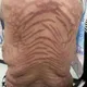 影/嚇人！網購藥膏塗10年　陸女腎上腺異常全身長滿蛇紋