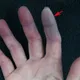 手指變紫以為末梢循環差！看診無效竟是罕見「硬皮症」
