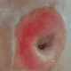 嚇！陸女誤把「皮脂腺囊腫」當痘痘擠　臉部驚現「恐怖黑洞」