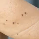 脖子、腋下狂冒小肉芽？醫師直問：你最近血糖測了嗎