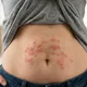 婦人肚子冒紅疹「不是濕疹」　醫一驚：癌症轉移了！