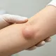 腫塊不痛不癢就沒事？6旬翁拖多年竟長成17公分骨腫瘤