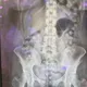 影/吞72顆毒膠囊！泰拳女教練走私360萬海洛因　10天排出