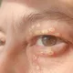 身上長4種黃色瘤？血管油脂恐已滿溢　醫：當心腦中風！