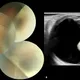 36歲女眼內有巨大腫瘤!北榮切除2公分惡性瘤保住視力
