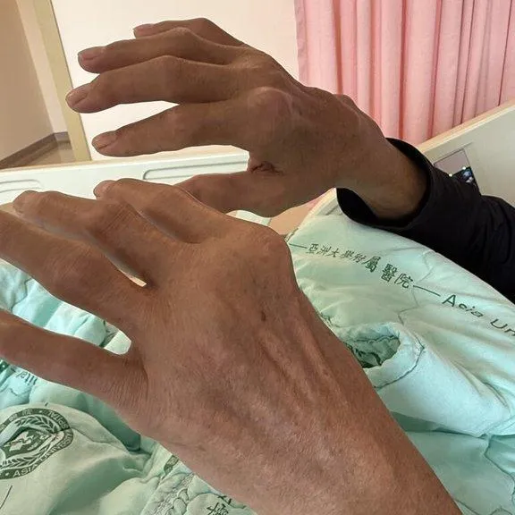 男子痛風石如雞蛋大破裂　醫：嚴重恐截肢