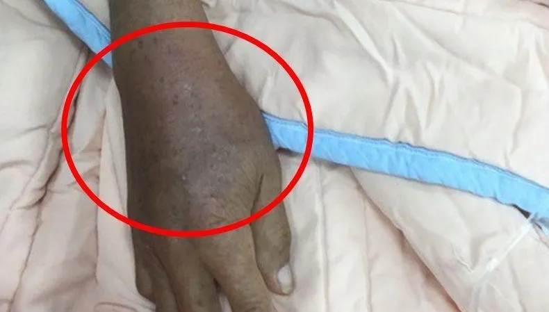 反覆發作的痛風好痛苦？醫師提醒：漠視不治療下場慘　腎臟病風險飆高
