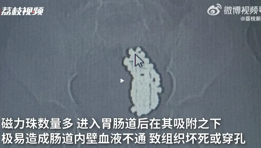 嚇壞！3歲女童連續嘔吐、腹痛不止　父送醫檢查照X光嚇壞：腸道「上百顆魚卵」結成一大球