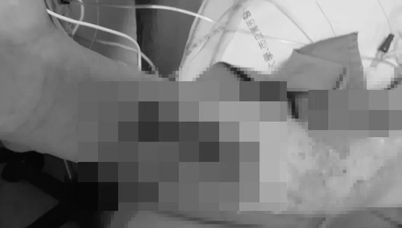 海邊釣魚遭刺傷！他3天後「手臂冒泡全爛」　醫揭恐怖關鍵警告：3類人一碰恐截肢
