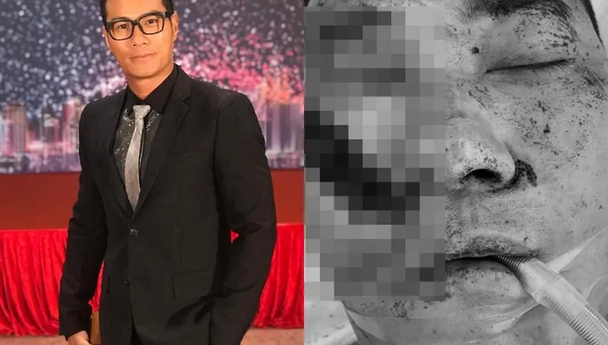 男星疑被尋錯仇「遭連砍3刀」險沒命！受傷照瘋傳「右大塊臉都沒了」恐破相