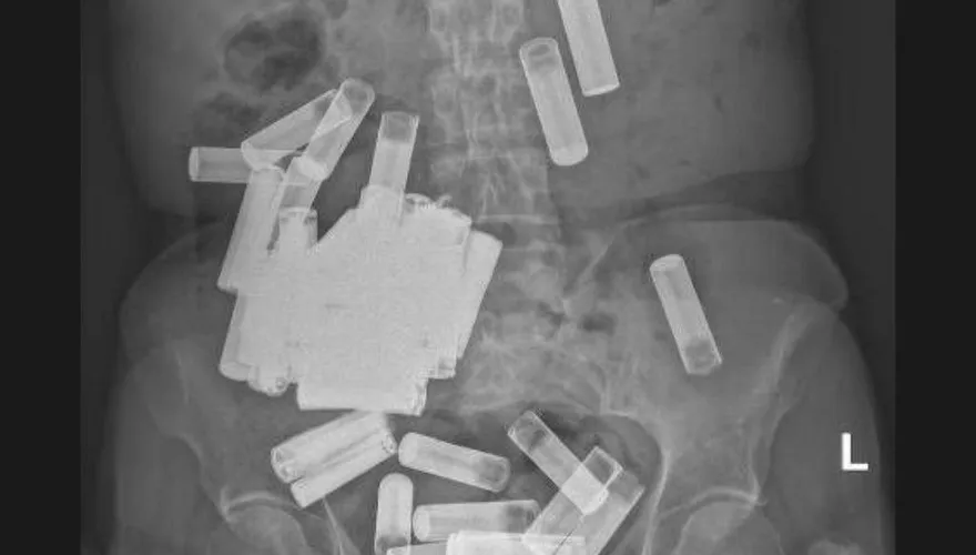 6旬婦肚子詭異脹痛！醫驚見「55顆電池」撐爆腸胃　驚悚X光照曝光