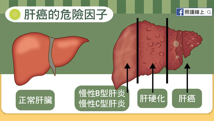 IARC報告：年增50萬例！全球肝癌病逝者上看130萬人  亞洲最多！