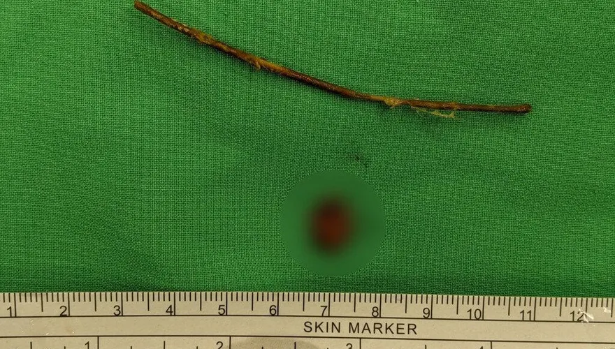 悚！1歲女童腹痛就醫　驚見「9公分樹枝」穿腸