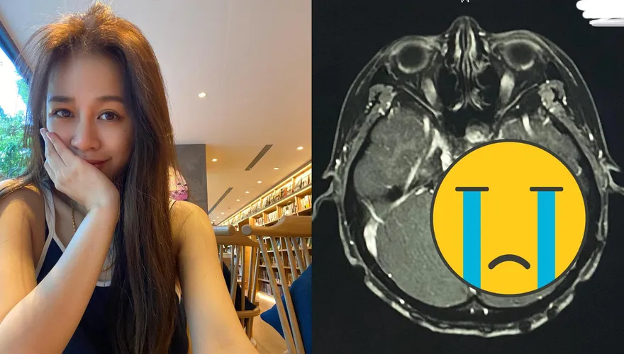 腦瘤切除3年後復發！女星治療1年「腫瘤大小不變」　「腦水腫→頭暈跌倒」現況曝