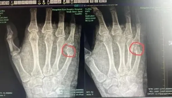 崩潰！一題講了半小時　爸爸教孩寫作業氣到捶桌致手掌骨折