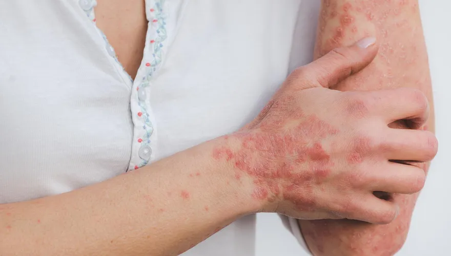 擺脫冬季癢！中醫教「內外雙修」保暖、補腎、保濕3管齊下！