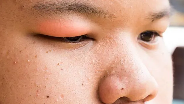 小孩愛吃巧克力易長針眼！醫曝：嚴重得全身麻醉做手術
