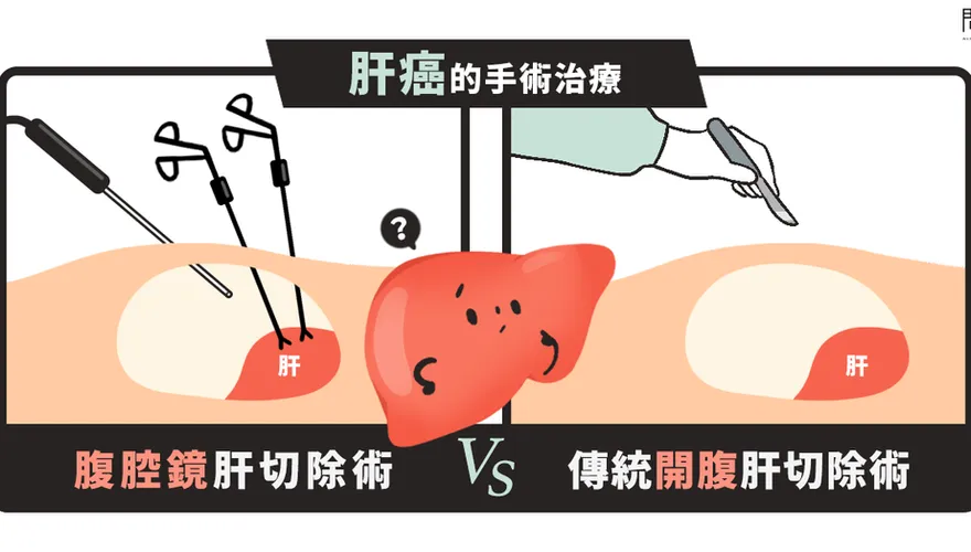 肝癌治療新選擇　醫曝新舊手術比較