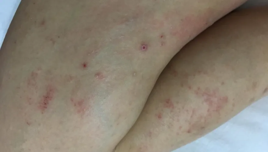 打完疫苗皮膚癢？醫：六症狀可能是嚴重藥物疹