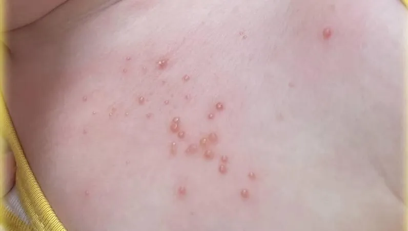 幼兒身上出現驚悚小珍珠！醫：恐是傳染性軟疣 兄弟姐妹都會被傳染