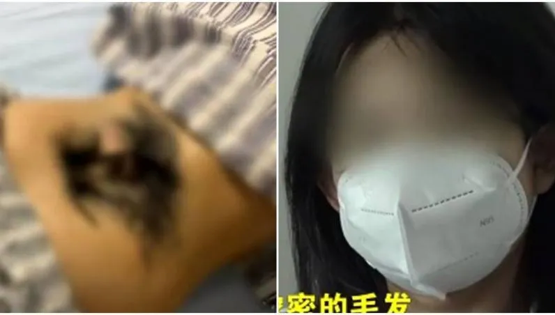 少女腰部長出「一叢濃密黑森林」　就醫竟是這裡有問題