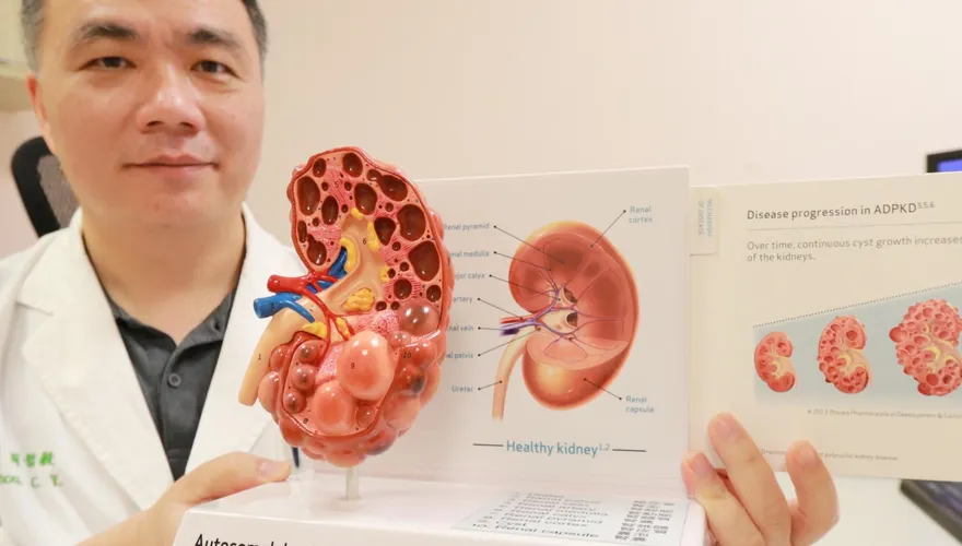 男腰痛、血尿導致腎臟腫3倍大「如一串葡萄」！醫籲及早篩檢以防洗腎