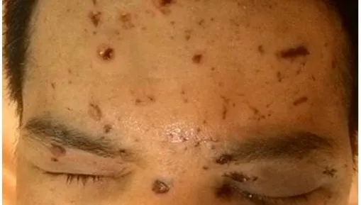 卡式爐「氣爆」意外40歲男視力僅剩0.2！台中榮總挽救珍貴視力