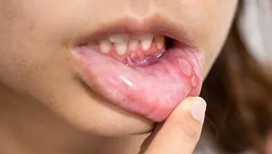 口腔癌大揭密！嘴破是口腔癌前兆？醫：愛做這3件事「罹癌率高123倍」