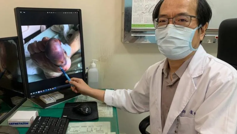 驚！老人跌倒「錯誤止血」恐截肢　醫師教3步驟正確處理傷口