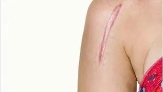 手術後不想留疤？整形醫師教「4件事」預防「蟹足腫」
