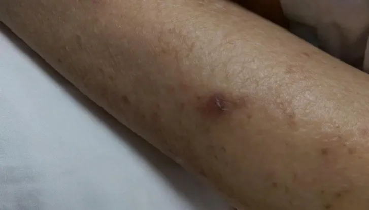 噁！8旬嬤皮膚癢就醫　驚見皮膚「被蟲挖地道」！一人中標全家都有