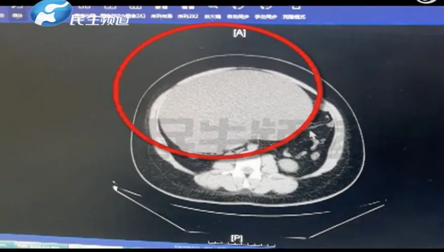 比足球還大！誤以為「發胖」狂減肥瘦不下來　竟是腹內長8公斤重卵巢囊腫