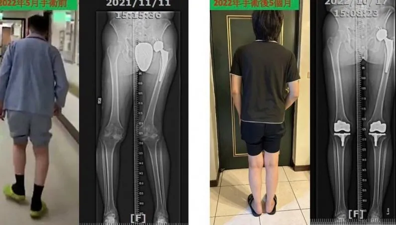 挑戰極限！重度血友病患者多關節一次換　 整合治療照護更全面