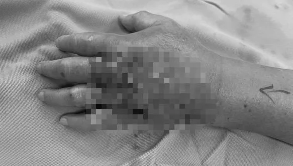 慎入！老翁被魚「刺出傷口」拖兩天腫脹、發燒　竟是「敗血性休克」險截肢！