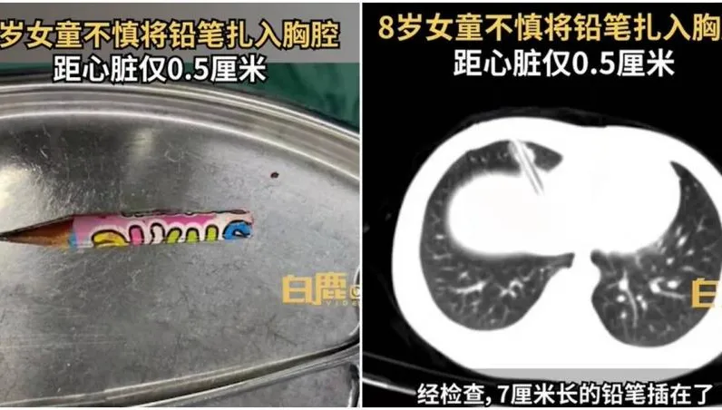 悚！女童玩耍跌倒「鉛筆插胸腔」　離心臟竟不到0.5公分！