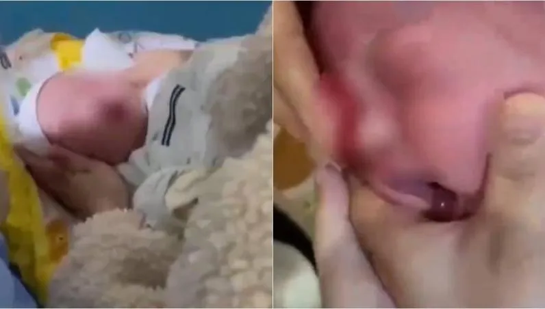 太誇張！天兵月嫂誤「拿酒精洗眼睛」　出生28天女嬰「眼角膜燒傷」哀號大哭
