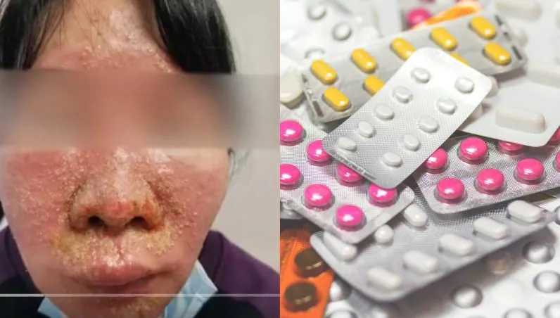 【影】真「藥」命！全身長滿膿包紅斑險死　竟因自行「混吃」7種感冒藥