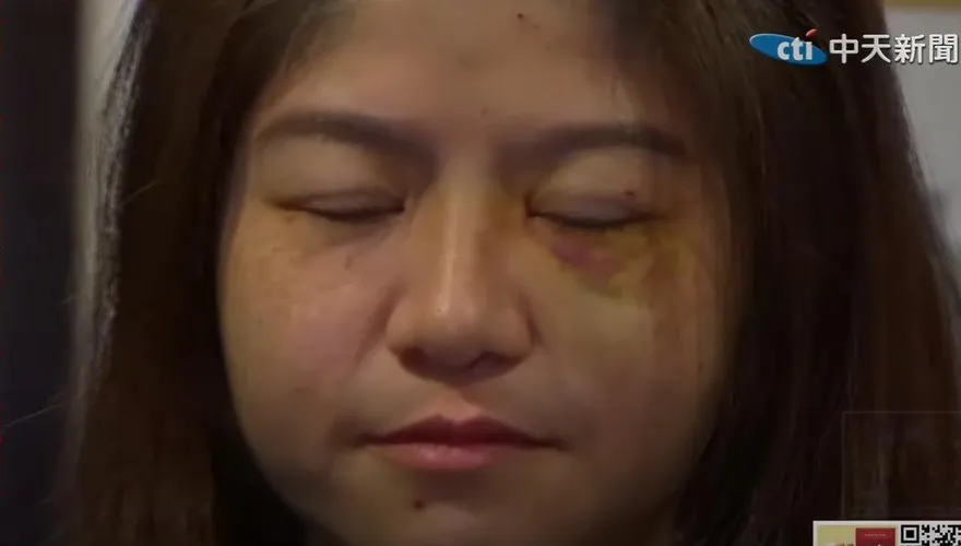 太玄宮女執事稱臉是被眼鏡刮傷　網友：怎麼看都是瘀青
