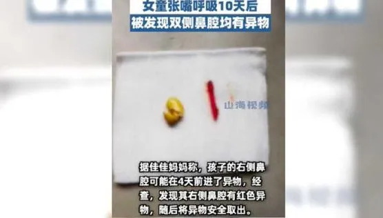 2歲幼童誤將黃豆塞入鼻10多天　醫師取出「竟然悄悄發芽了」