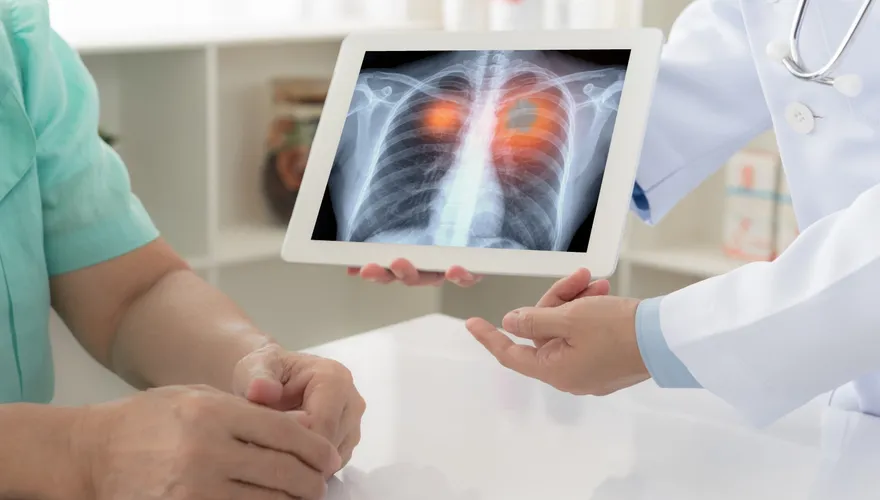 婦腰痛就醫檢查才知罹「肺癌末期」！一查驚見7手足「4人罹癌」
