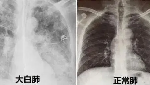 台商染疫成「大白肺」後保住生命！醫嘆：恐臥床終生