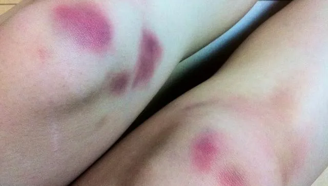 40歲女「全身瘀青」就醫傻眼竟是「肝癌」　醫揭「1狀況」要小心！