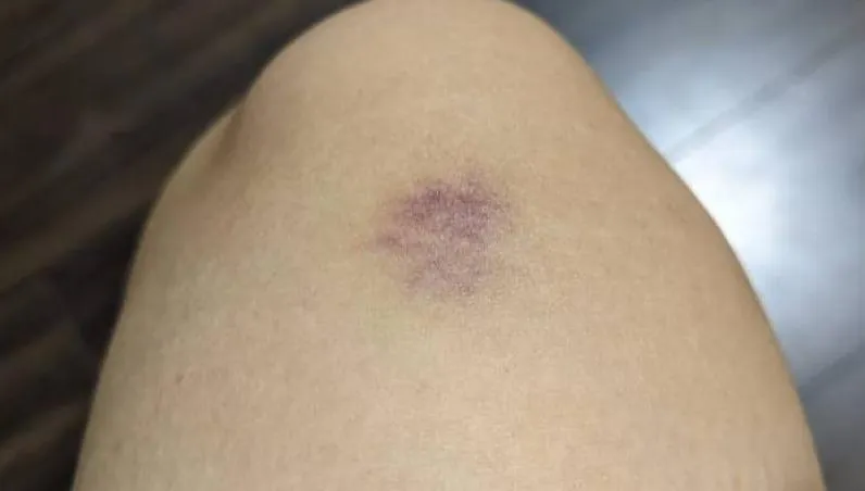 4歲童滿腿瘀青「疑遭暴力對待」　就醫檢查才知罹患嚴重疾病　肝腎恐出問題