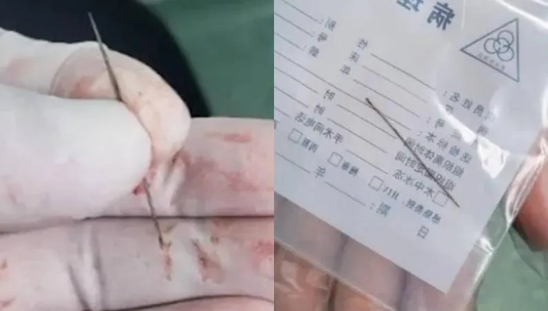 27歲男胸痛1個月就醫驚見2.4公分異物插肺　取出「生鏽繡花針」醫傻眼！