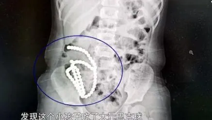 4歲女童「腹痛一個月」就醫驚見「61顆磁力球」　醫：毀了一輩子！