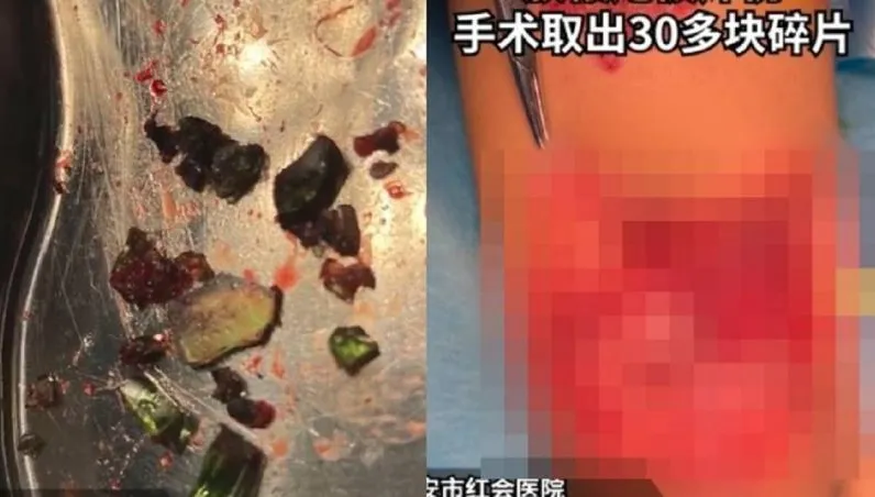 屁孩「鞭炮塞玻璃瓶」被炸成重傷！　網見巨洞傷口喊「不值得同情！」