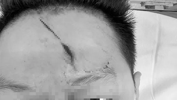 影/超慘！男逛新竹年貨大街遭電線絆倒撞頭縫10針　幼子也受傷市府急處理