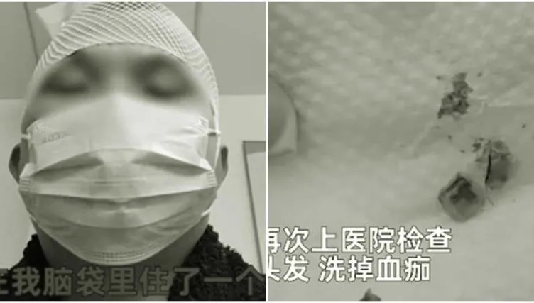 影/打完籃球6天後「頭頂散發腐臭味」　就診一查懵了：「長」了2顆牙