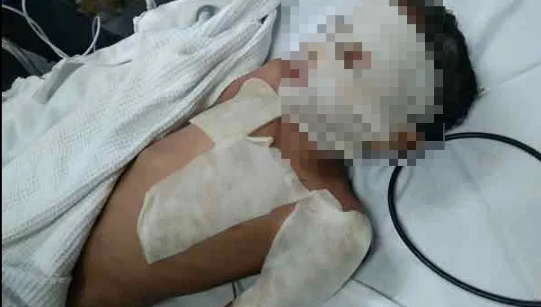 鄰居買小蘇打粉通水管！竟引爆樓下廚房爆炸　9歲男童「毀容恐失明」