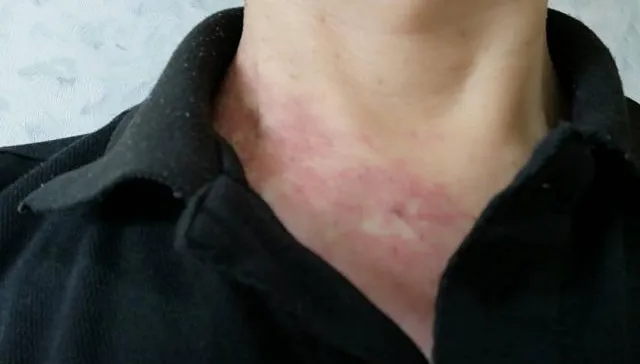 真的要注意！食道癌好發50歲以上男性 出現吞嚥困難往往已是中晚期
